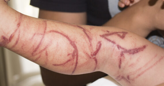 a severe jellyfish sting on a person's leg